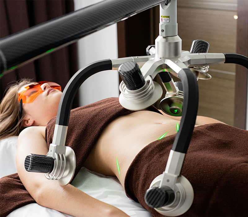 Thread lift to tighten facial contours